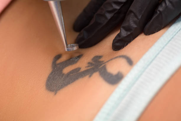 détatouage laser à Villefranche