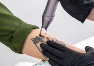détatouage laser à Villefranche