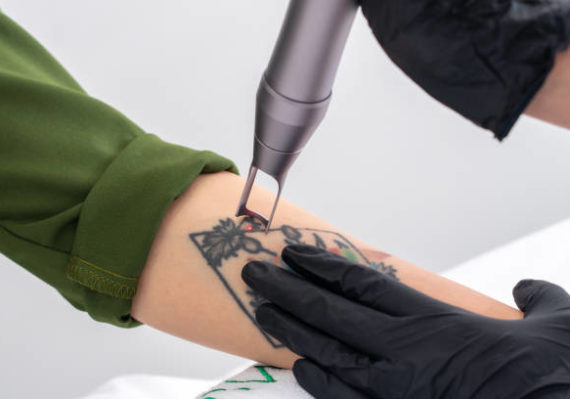 détatouage laser à Villefranche