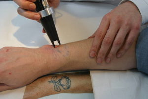 détatouage laser