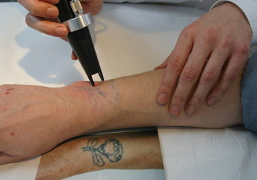 détatouage laser